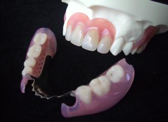 ノンクラスプ義歯（バネのない入れ歯）